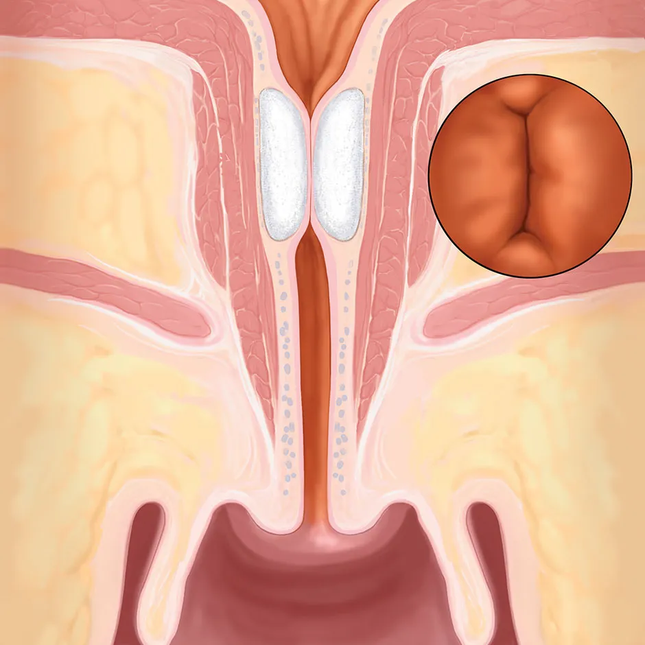 Coaptite injection procedure